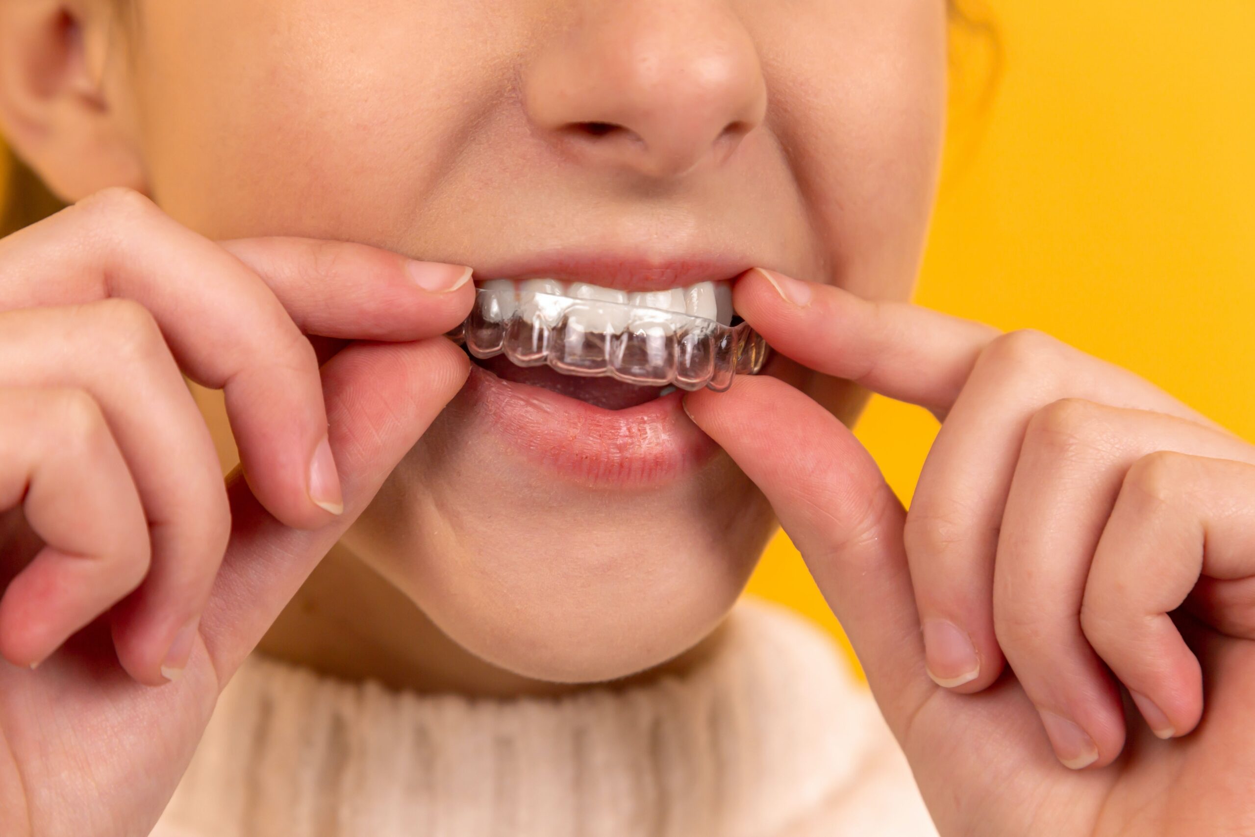 Invisalign Braces : FAQs
